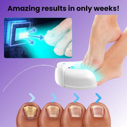 Nail Laser Treatment Device